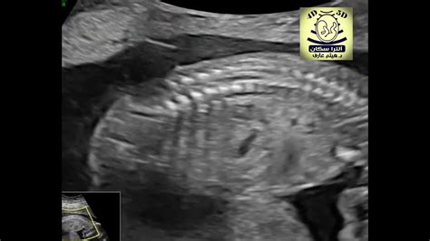 Spina Bifida Ultrasound Youtube