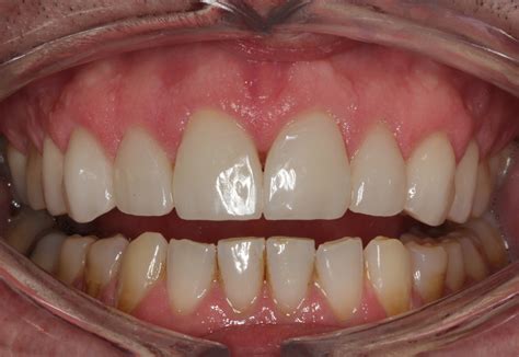 Add Enamel Your Teeth