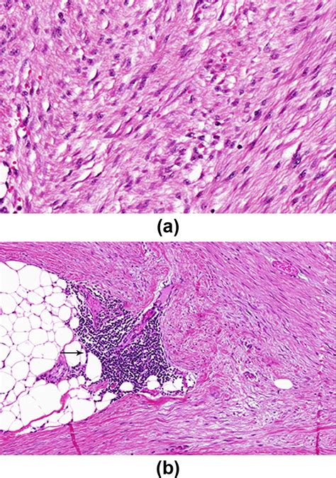 Fibromatosis Of The Breast A Pictorial Review Of The Imaging And Histopathology Findings