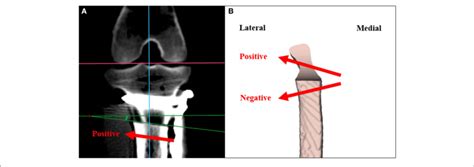 Measuring The Angulation Of Osteotomy For Inclination A The Angle