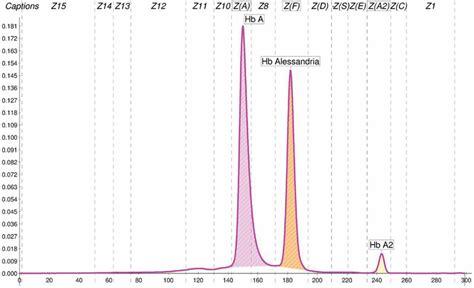 Capillary Electrophoresis Profile By Capillarys Flex Piercing Sebia