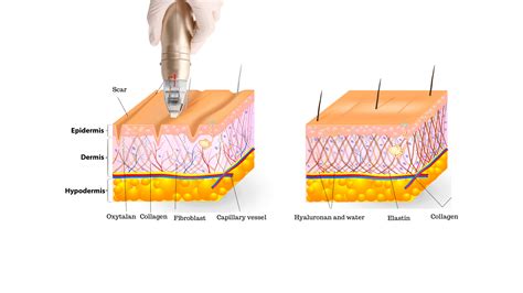 Acne Scar Diagram