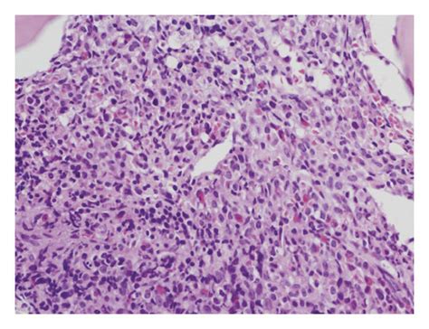 Bone Marrow Biopsy Showing A Hypercellular Marrow With Marked Myeloid