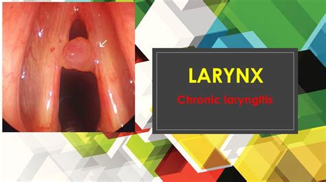 Chronic Laryngitis Youtube