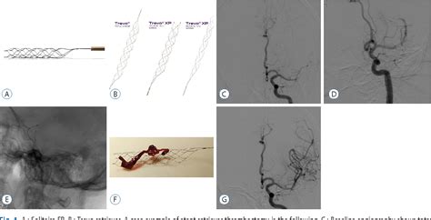 Figure 2 From Endovascular Stroke Therapy Focused On Stent Retriever