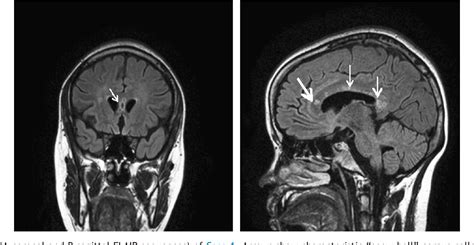 Figure From Optical Coherence Tomography In Susac S Syndrome