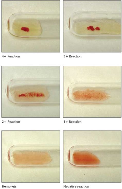 ~This is perfect~ Grading Agglutination Reactions | Medical laboratory, Medical lab technician ...