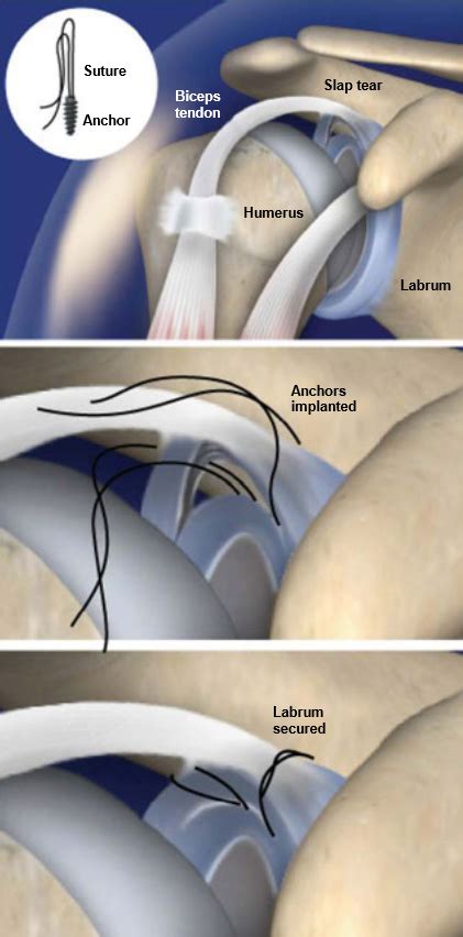 SLAP Repair | Central Coast Orthopedic Medical Group