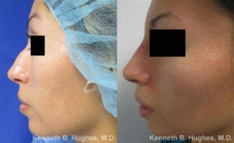 Rhinoplasty Procedure With Dr Hughes Los Angeles California 90066