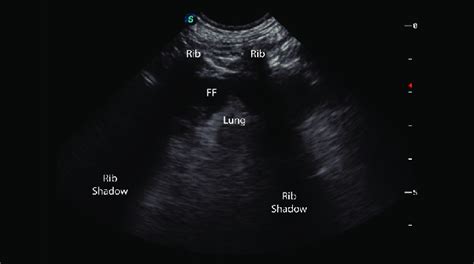 E Pleural Effusion Visualised At The Tfast Pericardial Site Ff Free