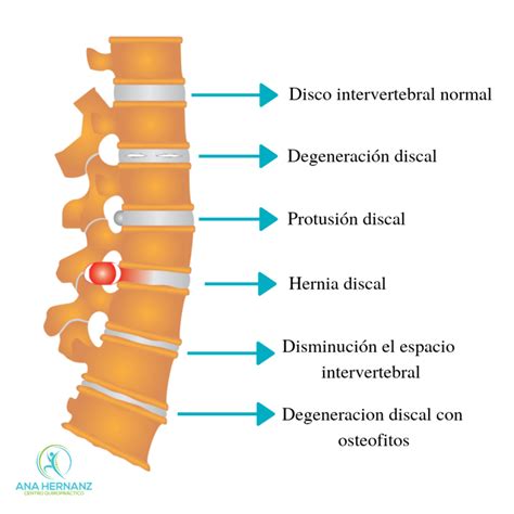 Hernia Discal Lumbar Y Tratamiento Quiropr Ctico Ana Quiropractica