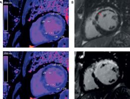 The Role Of Cardiac Magnetic Resonance Non Contrast T1 Mapping In