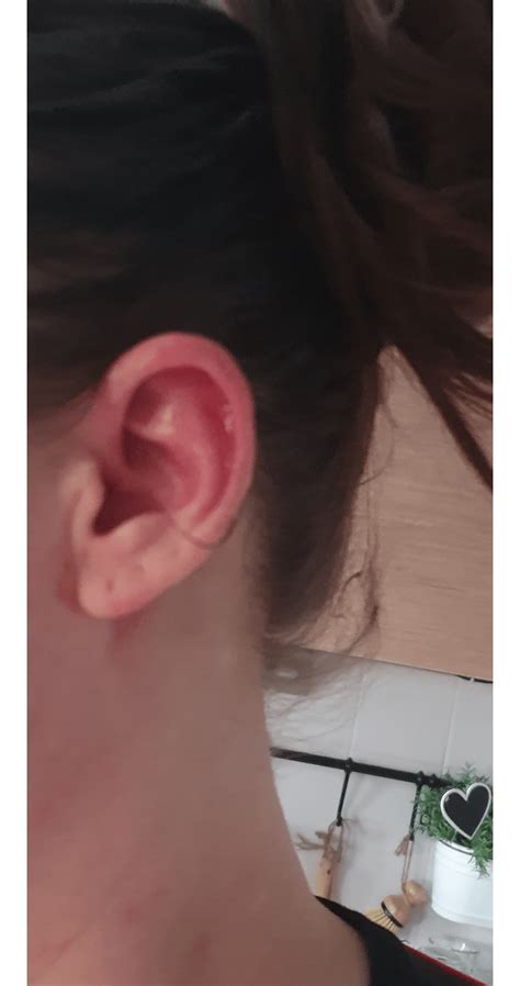 Red Hot Burning Ears A Symptom Recently Developed Dermatographia But