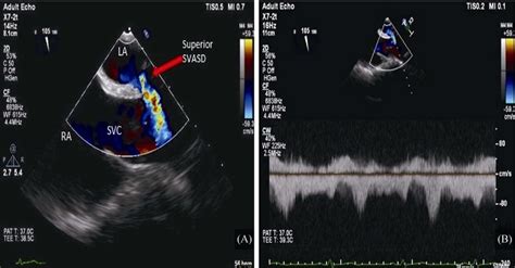 Sinus Venosus Atrial Septal Defect A Transthoracic Echocardiogram