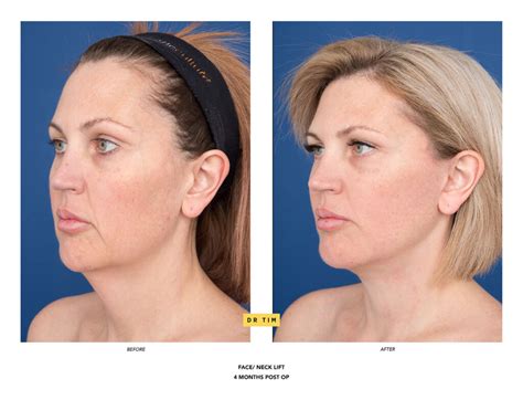 Platysmaplasty Neck Lift Sydney Dr Tim Papadopoulos