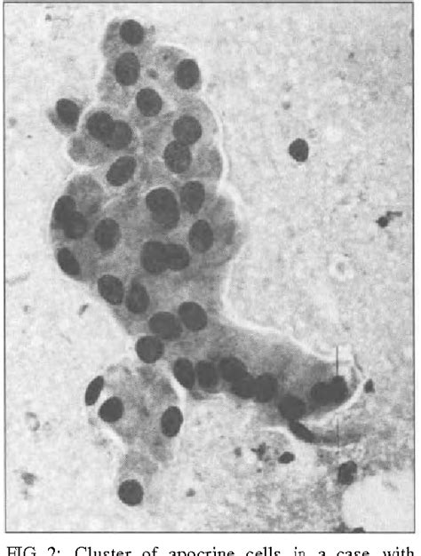 Figure 1 From Four Quadrant Fine Needle Aspiration Cytology For The Detection Of Benign