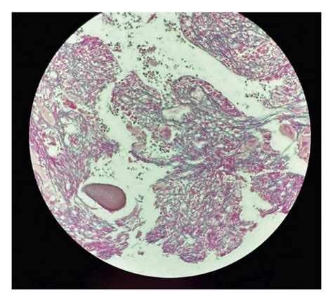Reticulin Stained Bone Marrow Core Biopsy Showing Increased Reticulin