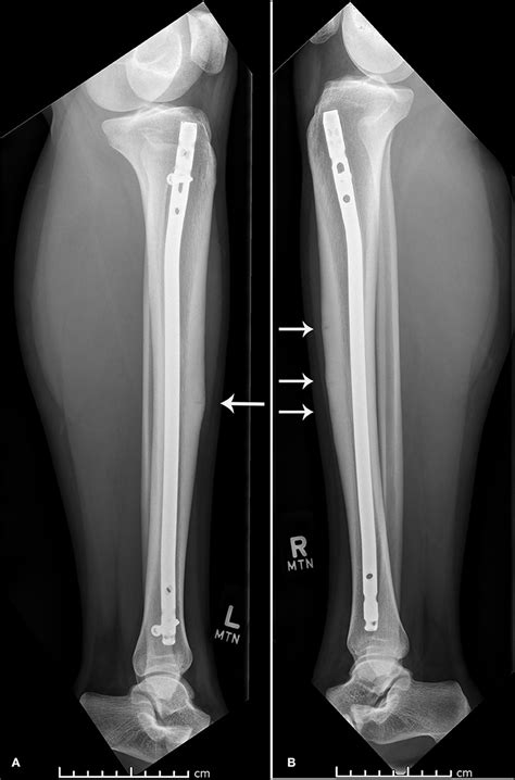 Anterior Tibial Stress Fracture