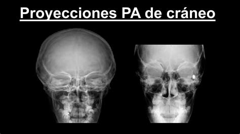 PROYECCIONES RADIOGRÁFICAS DE CRANEO PPT