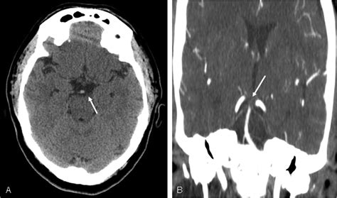 Coma Reversal After Basilar Artery Thrombolysis Neurology