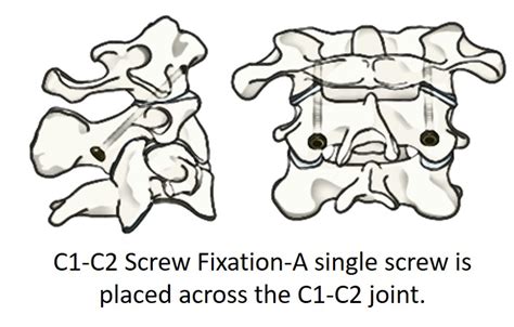 C1-C2 Fusion - Complications Are Common | Centeno-Schultz