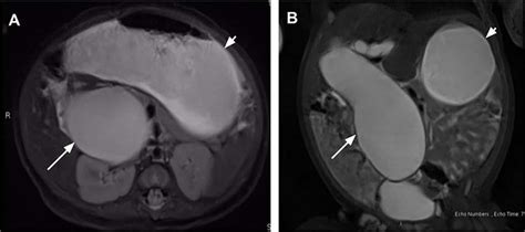 Magnetic Resonance Cholangiopancreatography On Day Of Life Dol 36 In Download Scientific