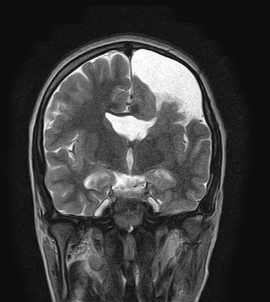 Schizencepphaly Closed Lip Radiology Case Radiopaedia Org