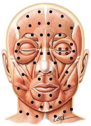 Rbcp Protocol For Bilateral Application Of Botulinum Toxin Type A To