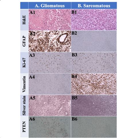 Gliosarcoma Images A Gliomatous Component Hematoxylin And Eosin