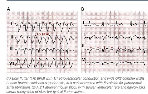 Figure 9 From Atrial Flutter Typical And Atypical A Review