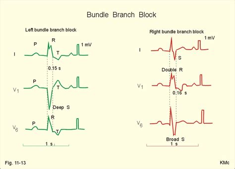 Ekg