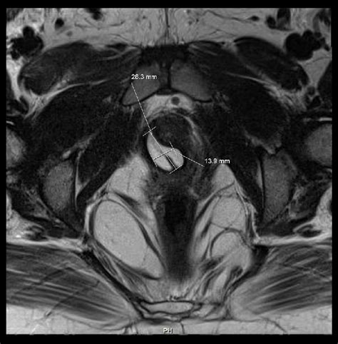 Follow Up Pelvic Magnetic Resonance Imaging Mri Follow Up Magnetic Download Scientific