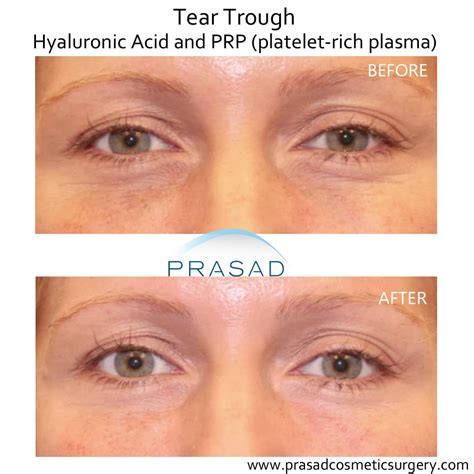 Under Eye Filler Before And After Photos Prasad Cosmetic Surgery Ny