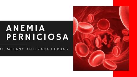 Anemia Perniciosa Melany Antezana Udocz