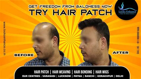 Hair Wigs Patna Mens Hair Patch In Patna Hair Wigs Patna Mens Hair