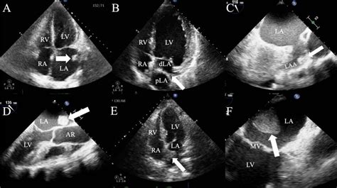 A Apical Four Chamber View Revealing Left Atrial Coumadin Ridge