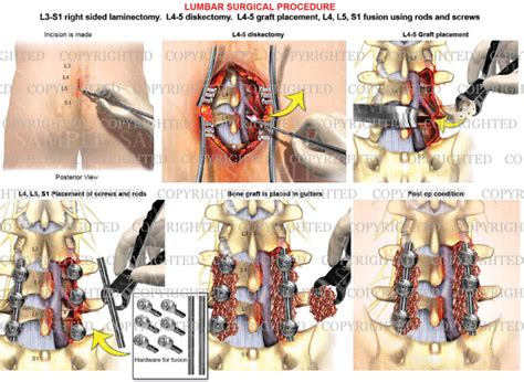 2 Level Posterior Lumbar Interbody Fusion Surgery — Medical Art Works