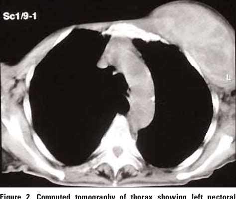 Figure 2 From Spontaneous Pectoral Hematoma Secondary To Enoxaparin For