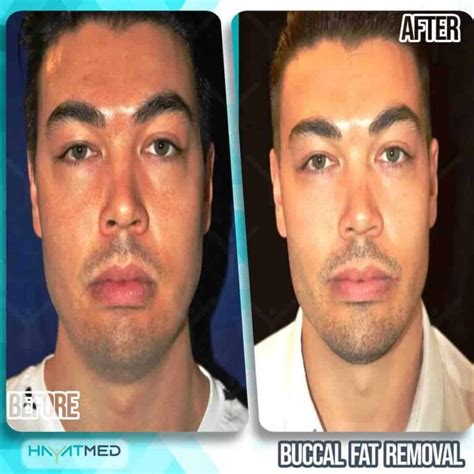 Buccal Fat Removal Procedure Ultimate Guide And Price