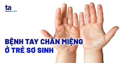 Phòng Ngừa Và điều Trị Bệnh Tay Chân Miệng Trẻ Sơ Sinh Hiệu Quả Tại Nhà