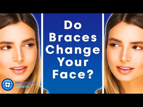 Do Braces Change Your Face The Impact Of Braces On Your Jawline