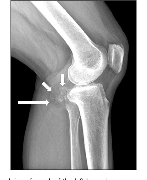 Pdf Osteochondrolipoma Presenting As A Popliteal Cyst Semantic Scholar