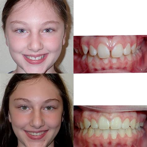 Before & After Braces | Wazio Orthodontics