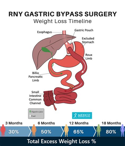 Bariatric Surgery Weight Loss Calculator