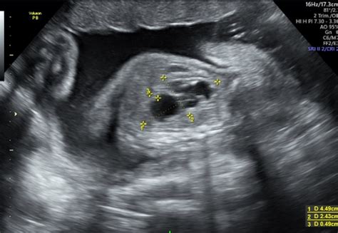 Fetal Hydronephrosis Ultrasound