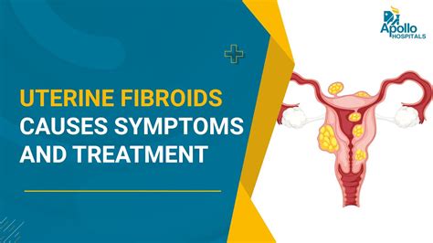 Uterine Fibroids Causes Symptoms And Treatment Gynaecology Dr