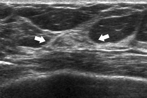 Asymmetric Mammographic Findings Based On The Fourth Edition Of Bi Rads