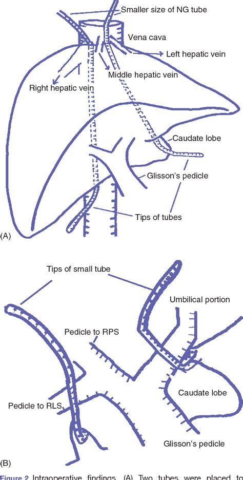 Figure 2 From Double Liver Hanging Manoeuvre For Central Hepatectomyhpb