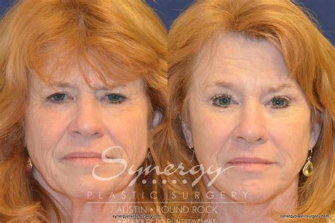 Brow Lift Eyelid Surgery For Austin Texas Synergy Plastic Surgery