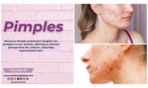 Understanding Pimples: A Comprehensive Overview of Pimple — Causes ...